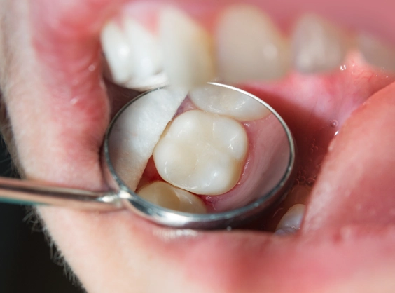 The Perfect Candidate Profile For Lingual Dental Braces